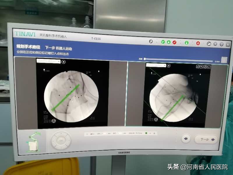 河南省人民医院协作院区,河南省人民医院做腰椎骨折手术