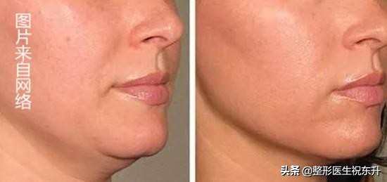 关于热玛吉是不是骗人的,热玛吉科普知识