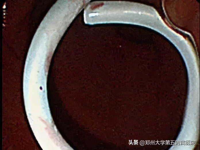 超声内镜下胰腺囊肿穿刺引流术,超声内镜下胰腺囊肿手术