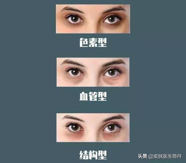 黑眼圈的治疗方法,黑眼圈的治疗方式的视频