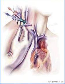 化疗埋管保证治疗顺利进行,一旦药物外渗患者遭罪又耽误治疗