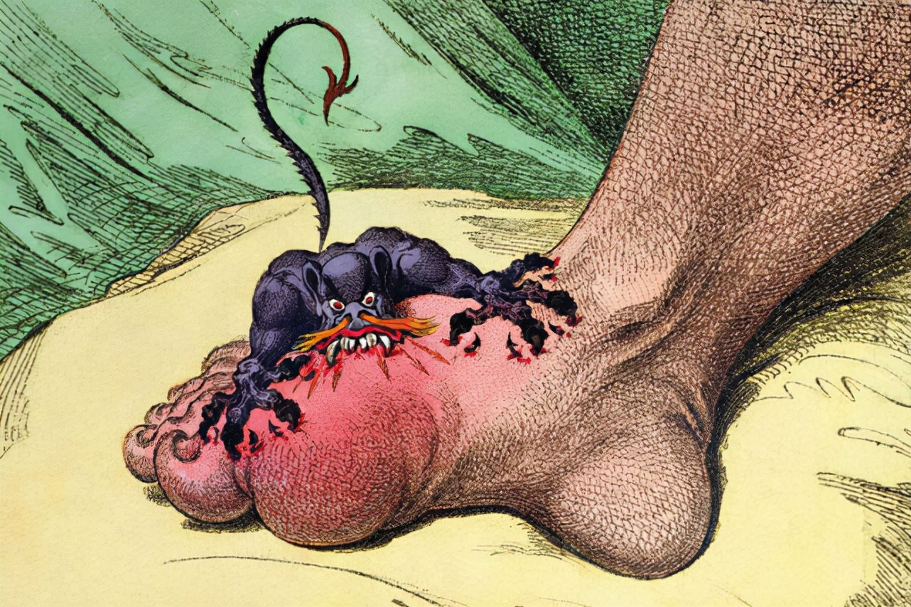 痛风的人很多，还在胡吃海塞？至少8000万国人正在受它折磨