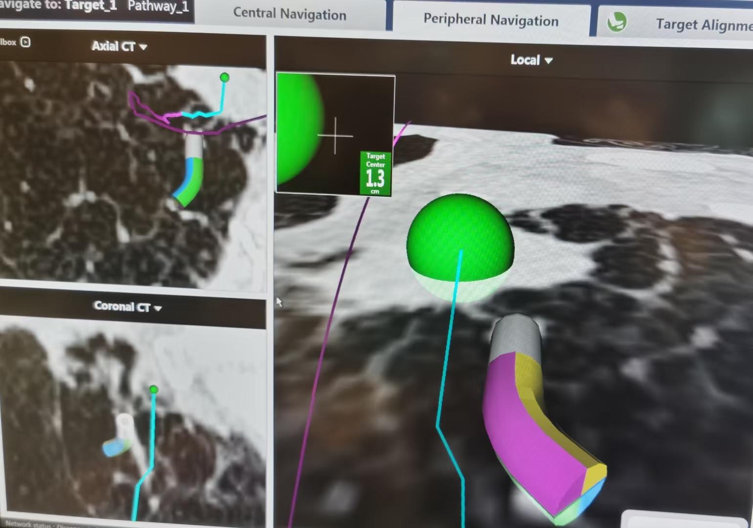 肺结节抗肿瘤治疗,肺结节诊治实例