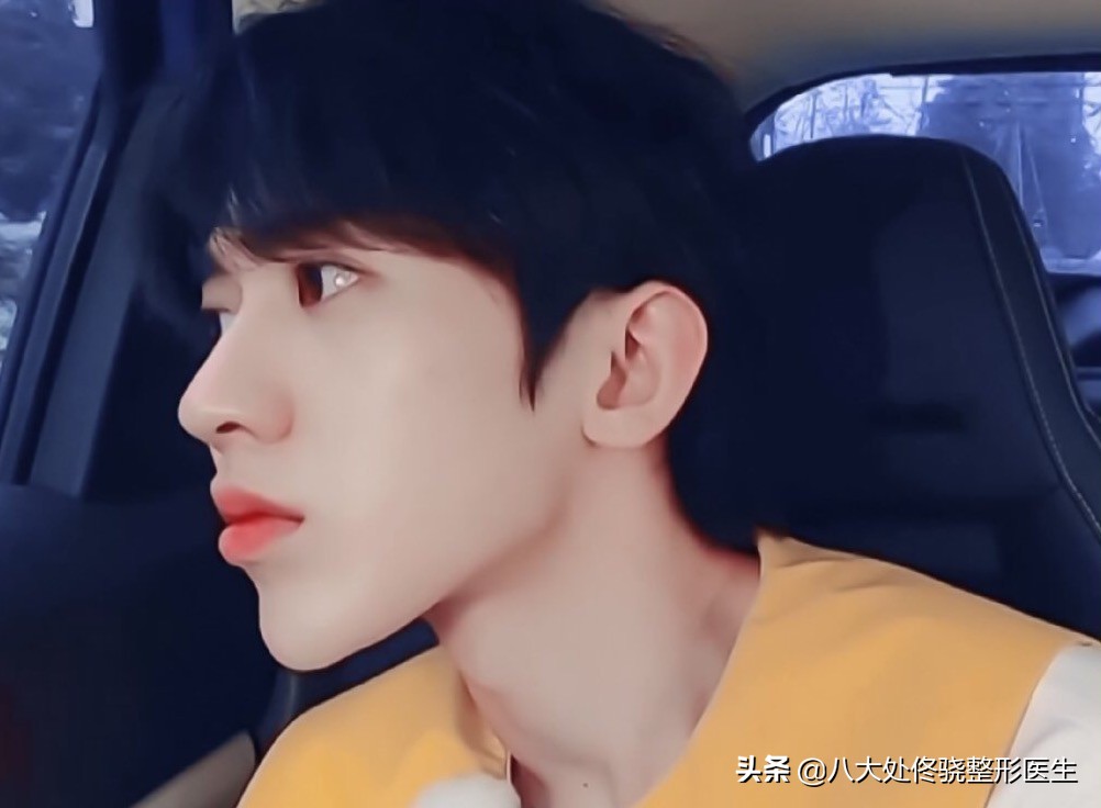 面部一枝花全靠鼻子当家,鼻子一针玻尿酸效果图