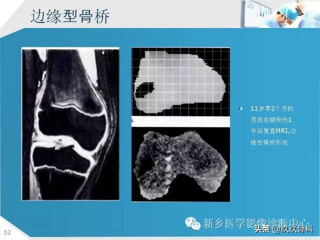 骨骺损伤x线表现,骨骺损伤磁共振表现