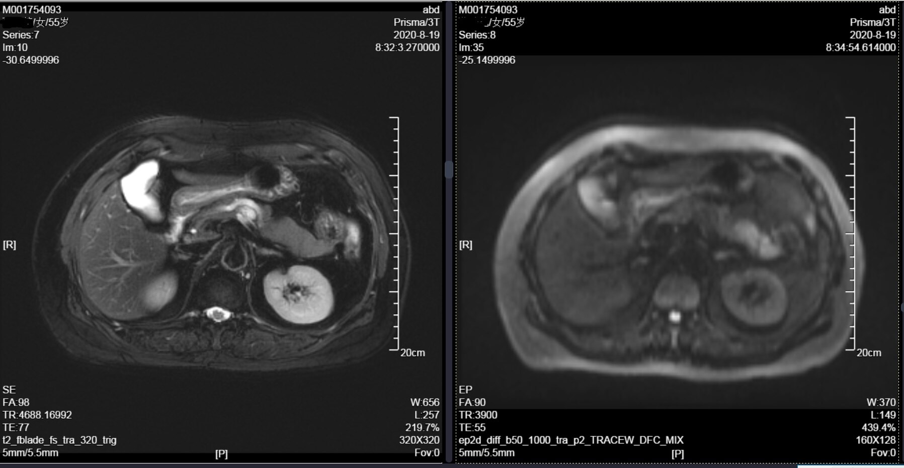 胰腺囊肿3.2x4.2必须手术吗,三厘米的胰腺头良性囊肿如何手术