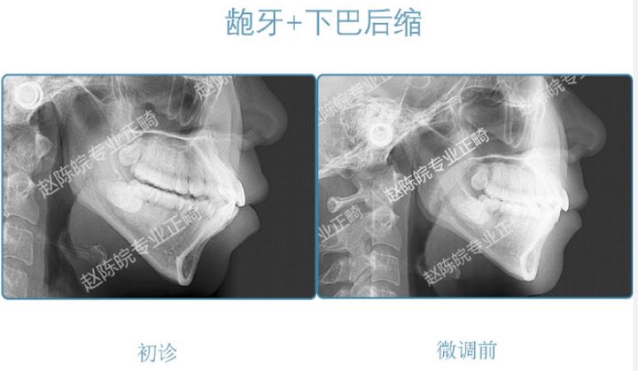 杭州成人隐形矫正牙齿优惠,矫正牙齿杭州无创伤