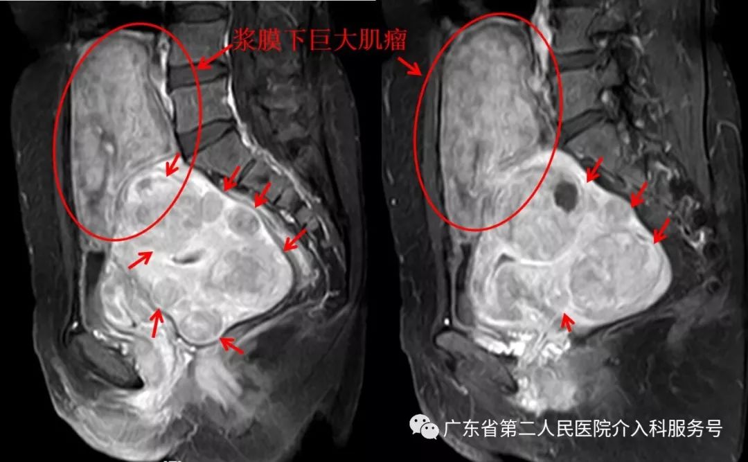 多发子宫肌瘤浆膜下,浆膜下多发子宫肌瘤怎么办