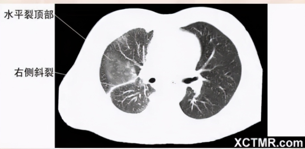 女性盆腔ct断层解剖结构图,女性盆腔脏器ct解剖