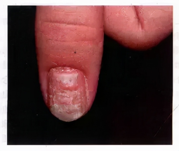 指甲竖纹发白变厚是怎么回事,涨知识了说明什么