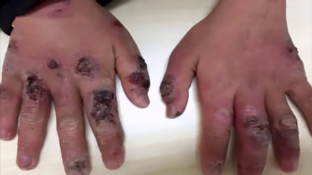 宝宝皮肤溃烂反复无法愈合,婴儿皮肤溃烂怎么治疗最有效