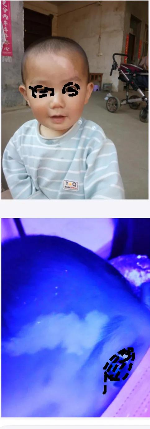 咨询故事：这个孩子额头的白斑是什么病？