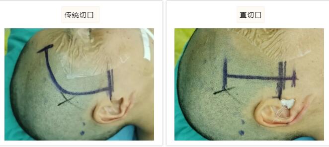 脑干肿瘤怎样才能发现,排除脑干肿瘤最简单的办法