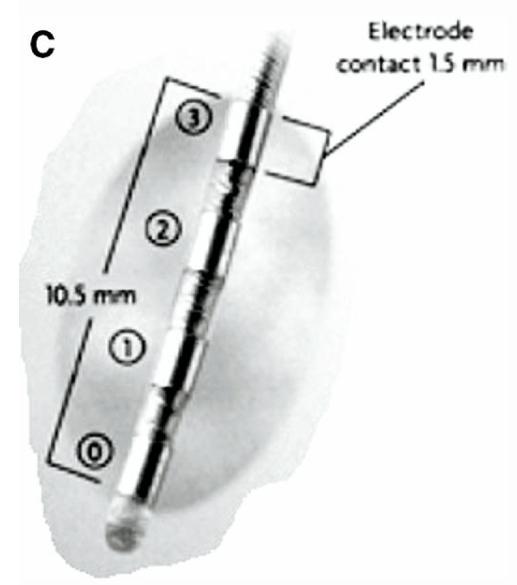 帕金森患者脑深部电刺激护理,帕金森脑深部电刺激手术步骤