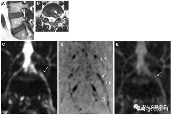 腰椎手术后神经根水肿要怎样治疗,腰椎融合术后神经根水肿吃中药