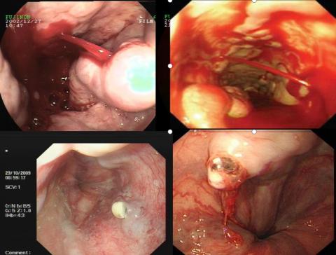 食管静脉曲张破裂出血常见症状,食管胃底静脉曲张破裂出血护理ppt