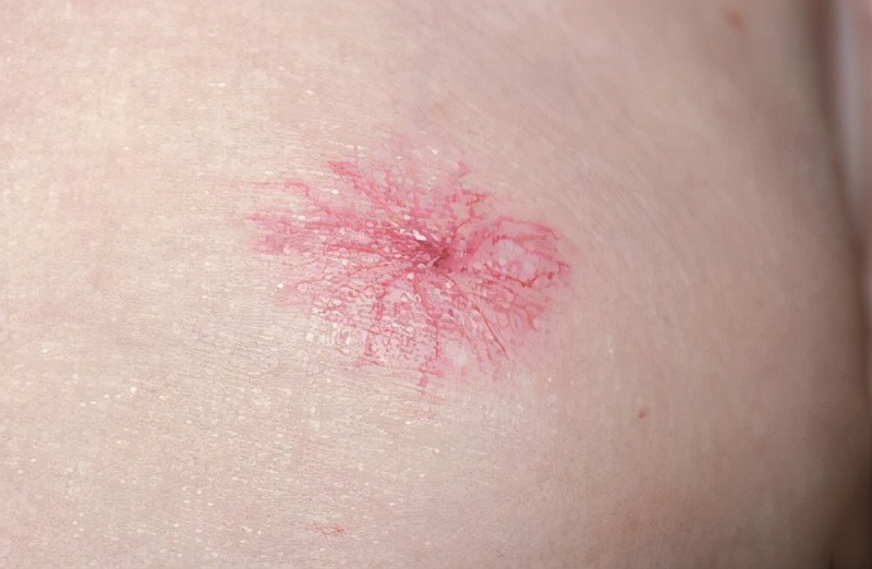 身上长红痣是肝病的前兆吗,皮肤长红痣是肝病的标志