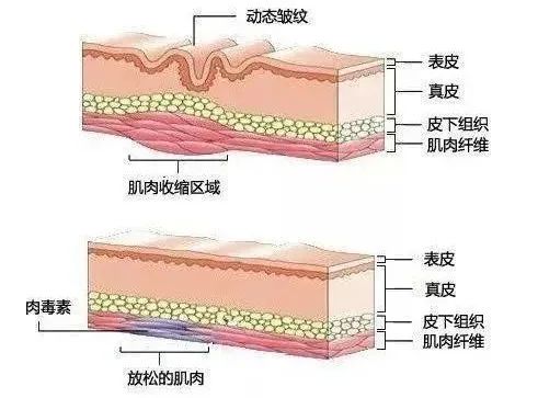 打瘦脸失败的案例,打瘦脸针出事故