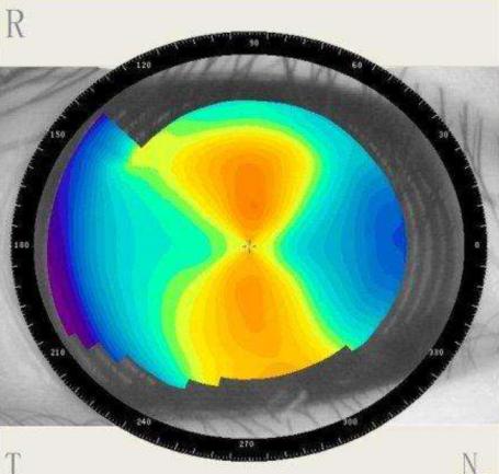 散光100对视力影响大吗,眼睛有散光对视力有什么影响