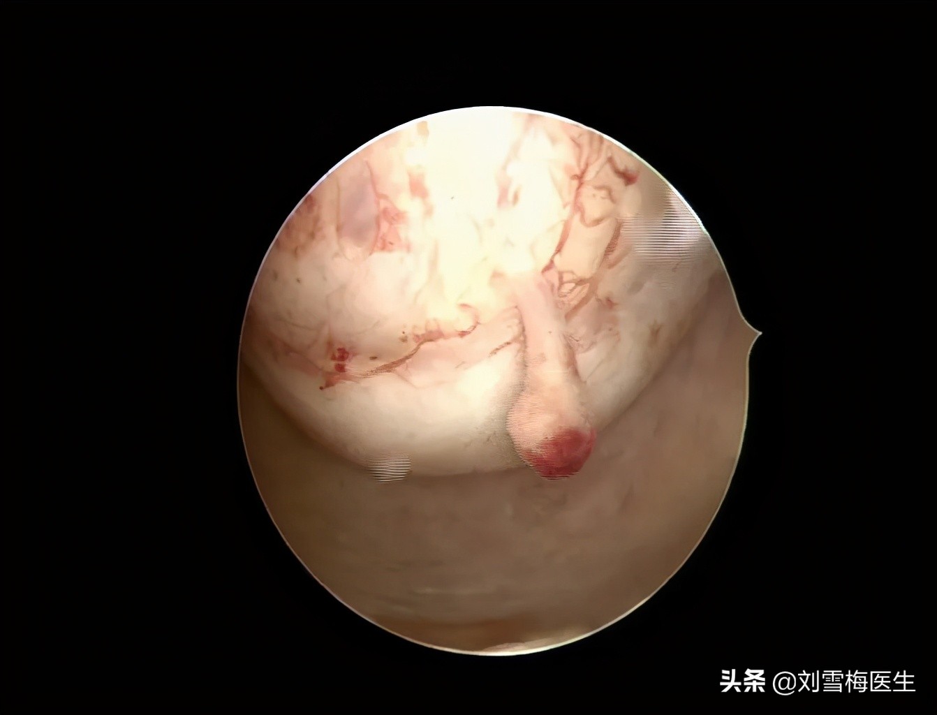 刘雪梅医生视频,刘雪梅大夫