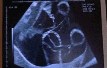 数胎动是怎样的算是有效胎动,数胎动时打嗝怎么算胎动