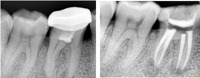 根管治疗和补牙哪个更贵,根管和补牙戴全瓷牙冠一共多少钱