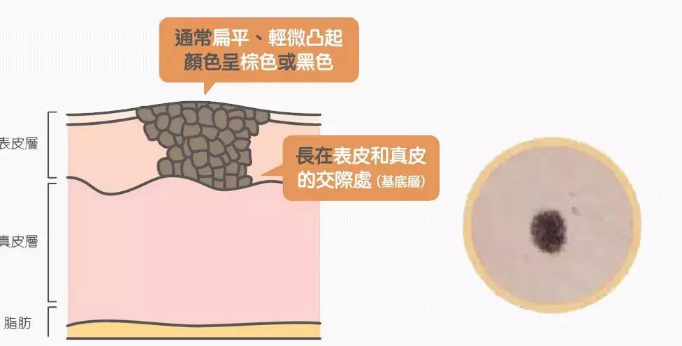 长在什么部位的痣最危险,长在哪些部位的痣需要特别注意