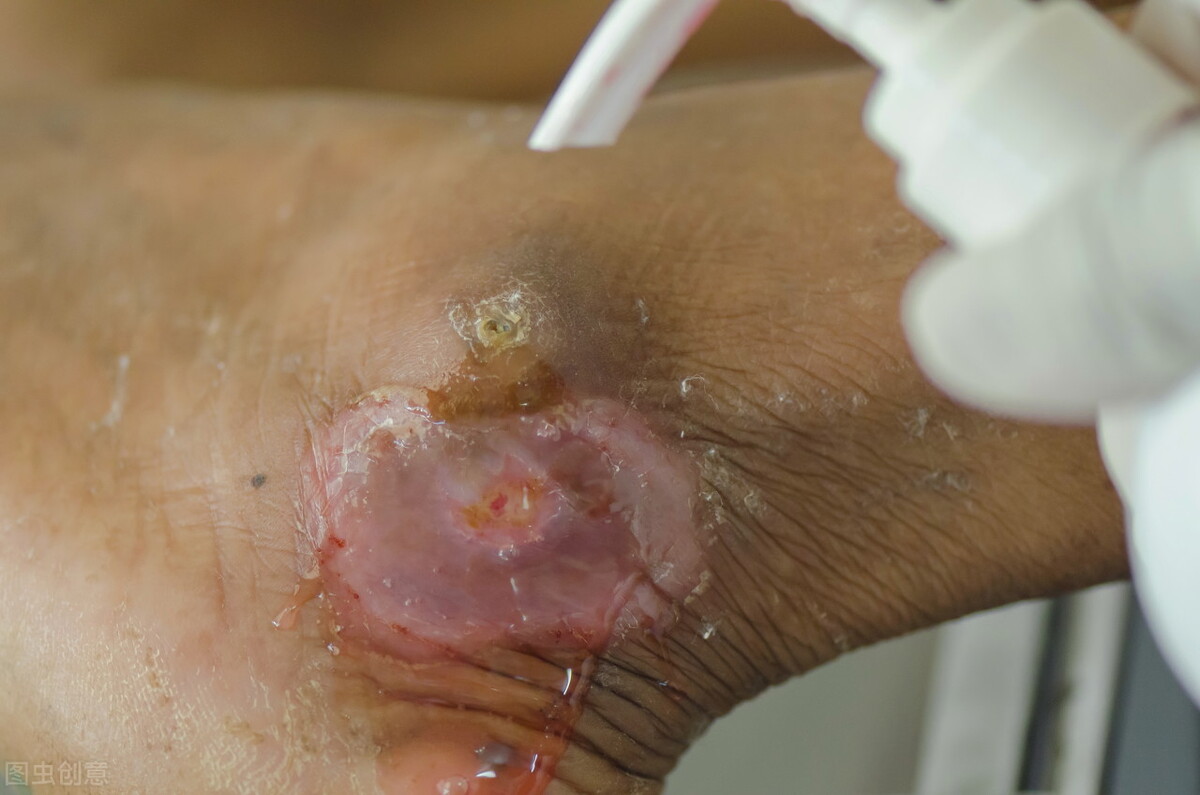 糖尿病足破溃期中医治疗方法,糖尿病足坏疽溃烂用什么药治疗