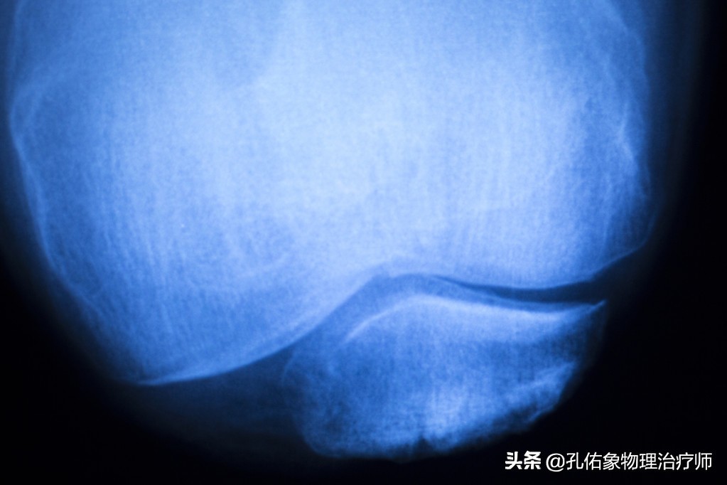 膝疼的最佳治疗方法,如何克服膝痛