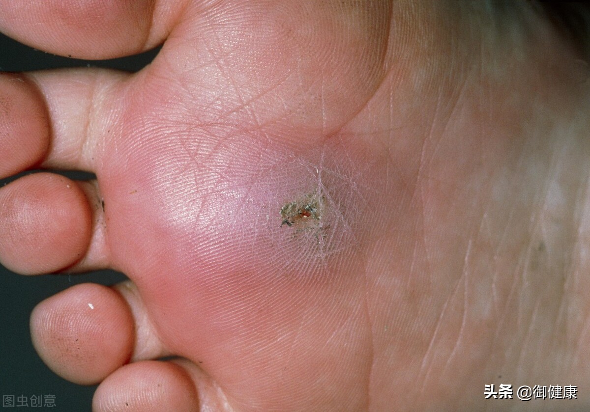 破伤风科普小知识,破伤风疫苗培训知识