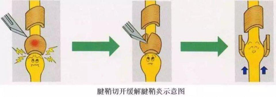 小孩手指狭窄性腱鞘炎有什么影响,儿童腱鞘炎手指弯曲伸不直