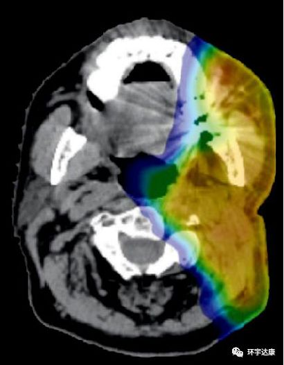 被誉为“抗癌神器”的质子治疗,这几类患者最适合