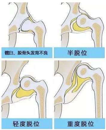 女性髋关节发育不良康复训练,35岁先天性髋关节发育不良修复术