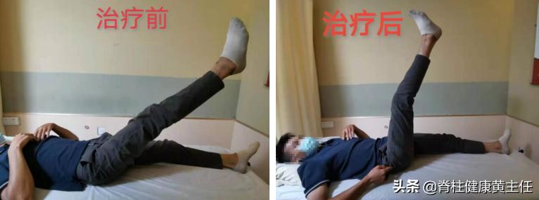 年纪大腰椎间盘突出治疗最好方法,年纪轻轻腰椎间盘突出怎么恢复