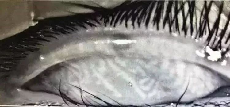 11岁孩子眼睛透支成中老年人,小朋友眼睛过度疲劳的危害