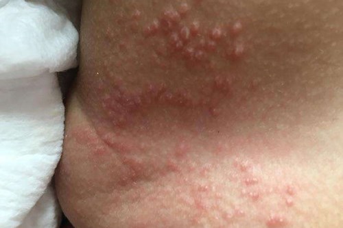 宝宝红臀最有效的治疗方法,关于红臀怎样预防和处理