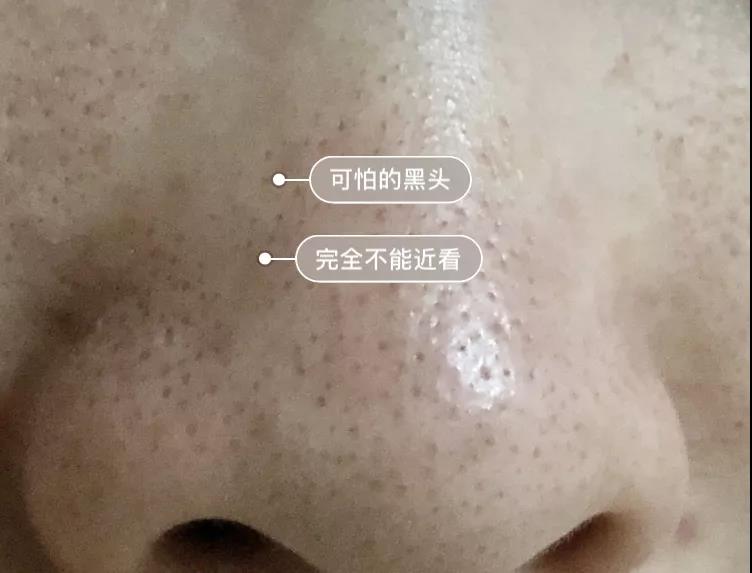 一秒去黑头去粉刺,一步就能搞定的黑头
