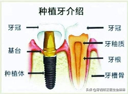 做烤瓷牙一颗3千,做三颗连桥的烤瓷牙多少钱