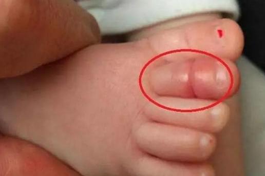 四岁孩子脚趾疼得很厉害,4岁孩子脚趾