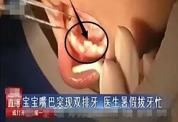 孩子出现双排牙该怎么办,孩子出双排牙怎么办