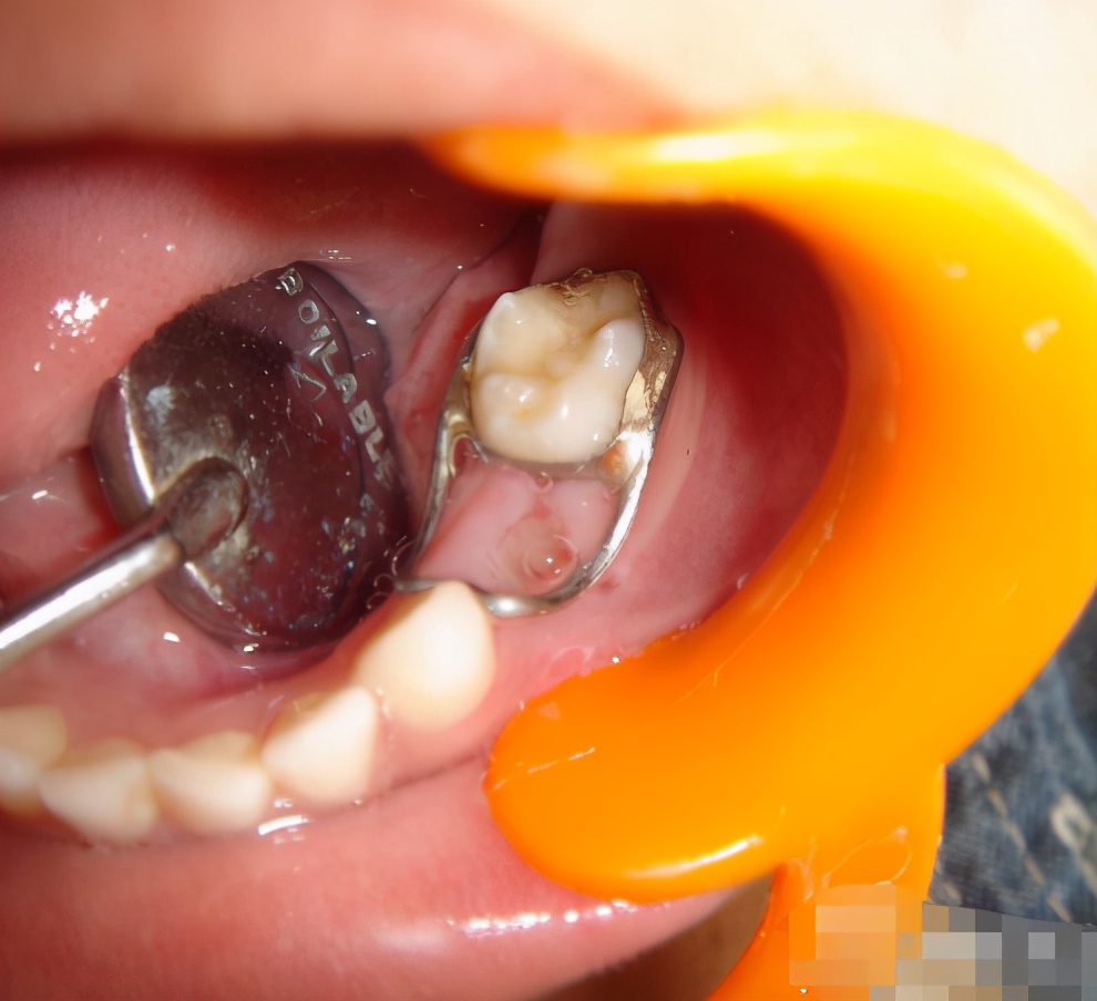 乳牙缺失恒牙长歪,恒牙缺失乳牙怎么补救