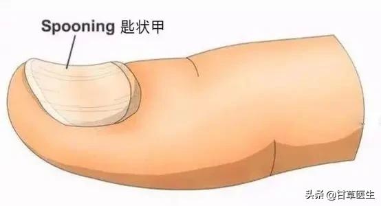 指甲出现这几种变化可能是肿瘤,心血管疾病指甲有变化吗