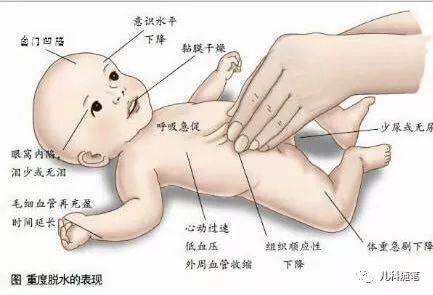 怎么判断孩子是否脱水严重,怎么判断儿童脱水的严重程度