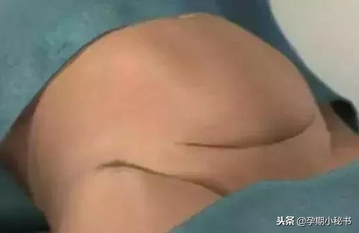 剖腹产最疼的是什么步骤,剖腹产手术步骤详解