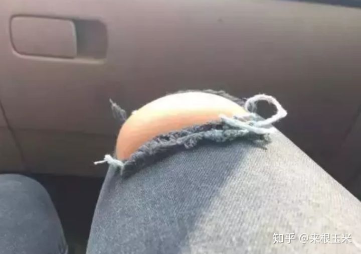 水肿腿加大象腿怎么瘦,大象腿赘肉多