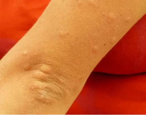 夏季蚊虫咬留疤怎么办,夏天蚊虫叮咬的疤会留白印吗