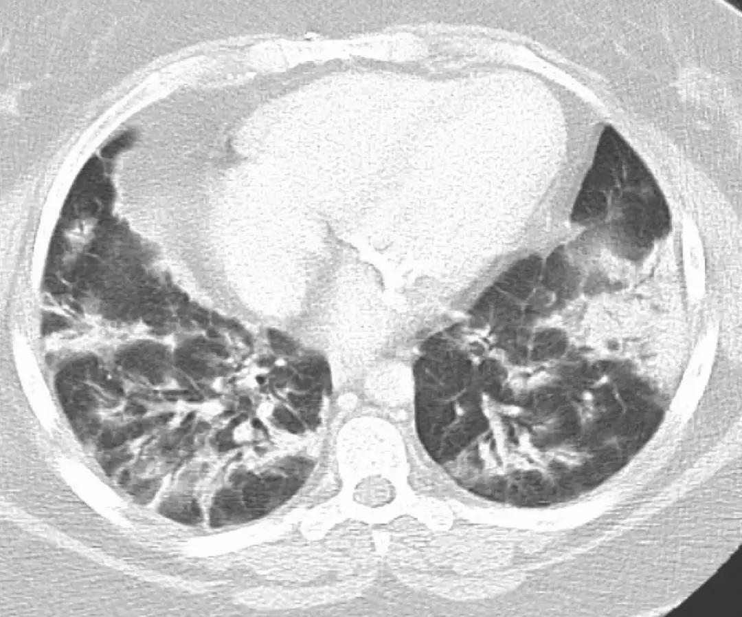 CACP2019:代华平:机化性肺炎的诊疗误区与防范