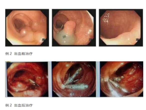 肠息肉切除术后出血了怎么办,肠息肉切除术后出血怎么办