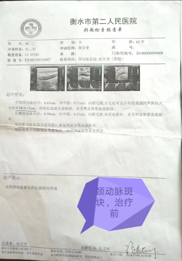 消斑块的秘方,祛血管斑块通络汤