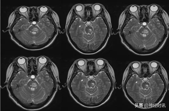 一例脑干出血的个案护理,外伤性脑干出血保守治疗成功案例